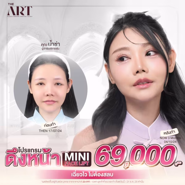 โปรโมชั่นดึงหน้าชั้นลึกแบบมินิ Mini Face Lift ที่ The Art Hospital ราคา 69,000 บาท พร้อมผลลัพธ์หลังทำจริงด้วยเทคนิคเฉพาะทาง
